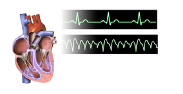 Тахикардия: симптомы, лечение