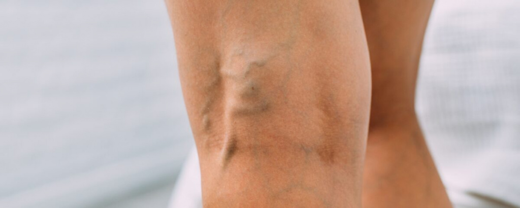legs-with-woman-with-varicose-veins-and-pronounced-2021-11-05-18-19-10-utc-1200x480.jpg legs-with-woman-with-varicose-veins-and-pronounced-2021-11-05-18-19-10-utc-1200x480.jpg