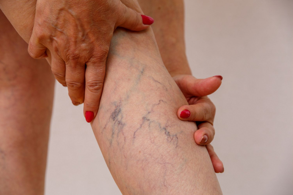 elderly-woman-shows-varicose-1145186766-cfb1326c1dac4189bbc78ca19847128b.jpg elderly-woman-shows-varicose-1145186766-cfb1326c1dac4189bbc78ca19847128b.jpg